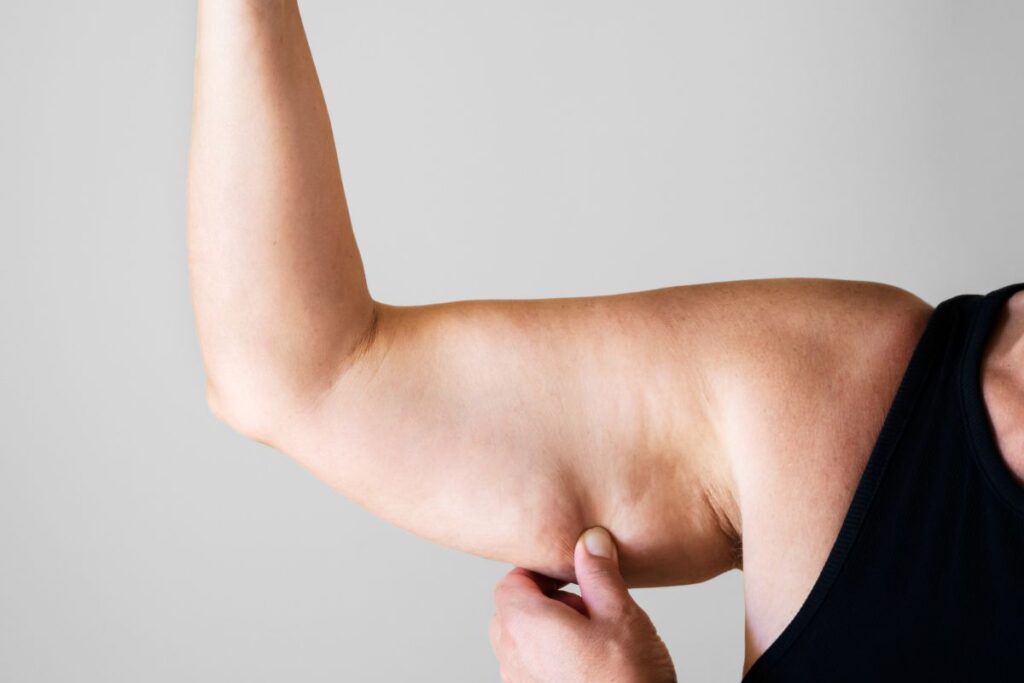 Kobieta ma lipodemię na ramionach
